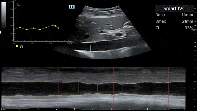 Smart Fluid Management: Smart IVC   