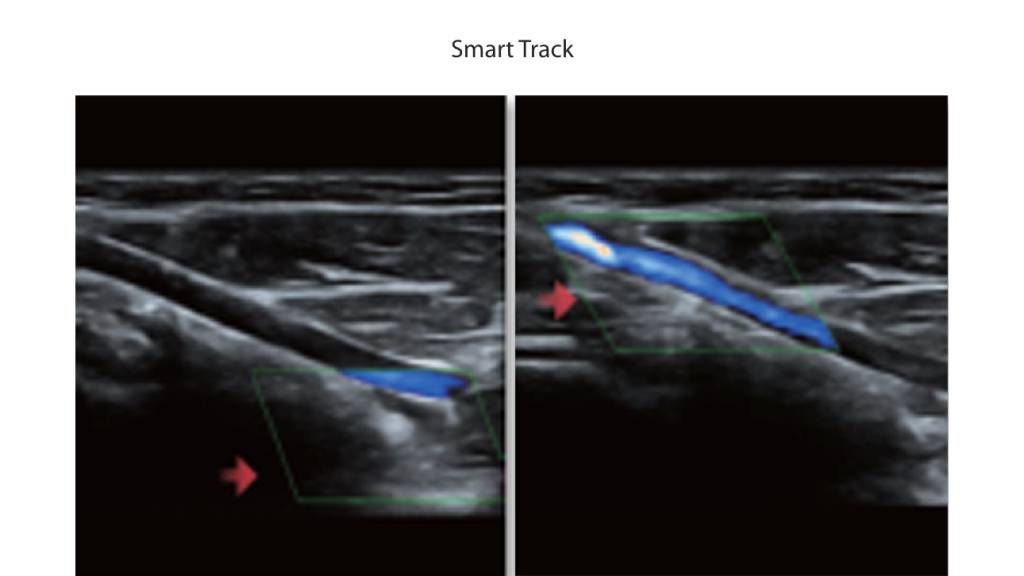 Smart Track provides a fast and intelligent optimization for vascular imaging with simply one-touch operation. It can optimize Color, Power and PW spectrum by self-tracking and reduce time-consuming steps. Therefore the vascular exam workflow is simplified with an optimal view.