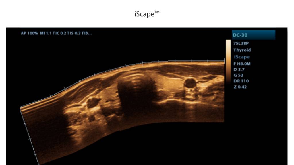 Get a complete and extended view of the anatomical structure through panoramic imaging coupled with velocity indication and forward/backward scan ability making scanning much easier, smoother and more controllable.