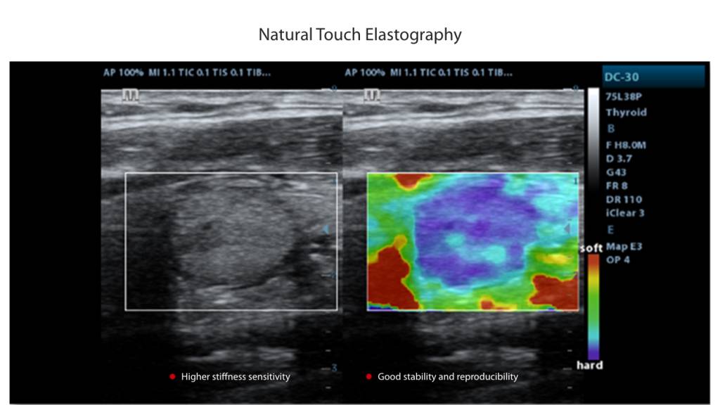 Based on Mindray’s latest patented technology, natural touch elastography reduces dependence on user operation technique, improving operator’s reproducibility for higher clinical utility.
