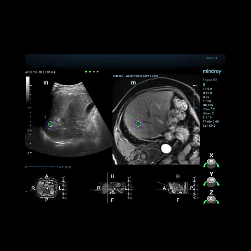 Mindray iFusion Ciljana MR/CT/PET-CT/3D UZV i ultrazvučna fuzijska biopsija prodaja zagreb hrvatska medexpert
