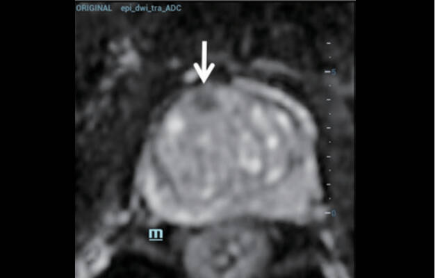 Lezija niskog signala u desnom prednjem režnju prostate bila je najjasnije prikazana na MRI sekvenci ADC (koeficijent prividne difuzije).