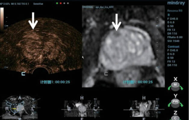 CEUS je pokazao rano pojačanje u području koje odgovara leziji viđenoj na MRI-u, u usporedbi s kontralateralnim perifernim tkivom.