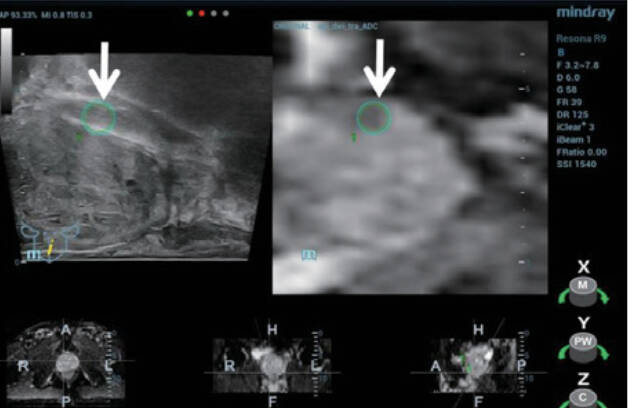 Vizualizacija igle za biopsiju pod iFusion navođenjem tijekom uzorkovanja donjeg dijela lezije.