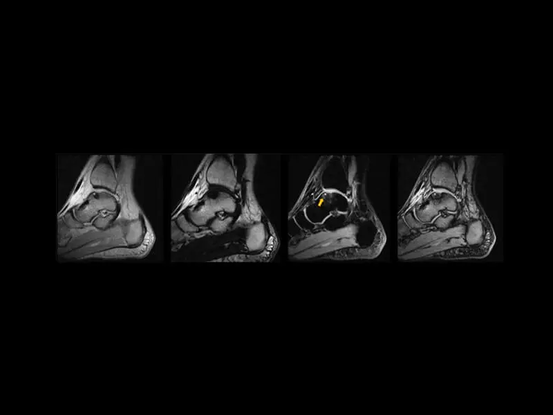 O-scan - Ankle XBONE sagittal