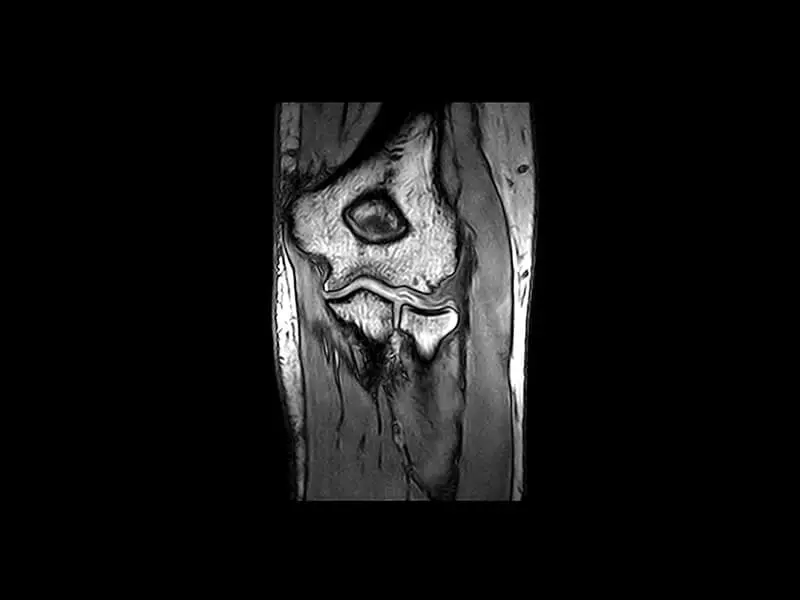 O-scan - Elbow 3D SHARC Coronal