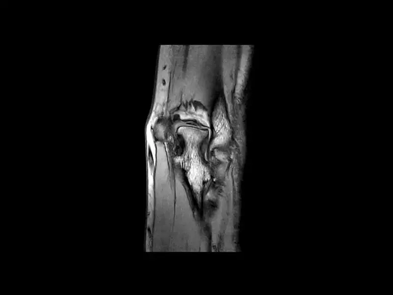 O-scan - Elbow GE T1 coronal