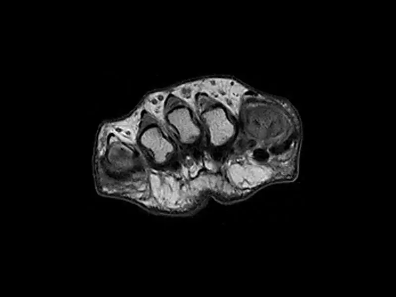 O-scan - Foot Spin Echo T1 Axial