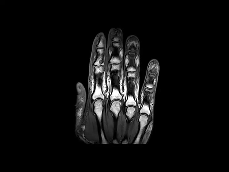 O-scan - Hand SE T1 coronal