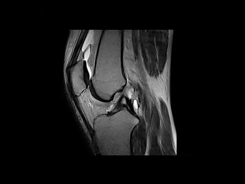 O-scan - Knee FSE T2 Sagittal