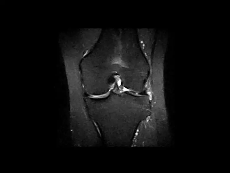 O-scan - Knee FSTIR coronal