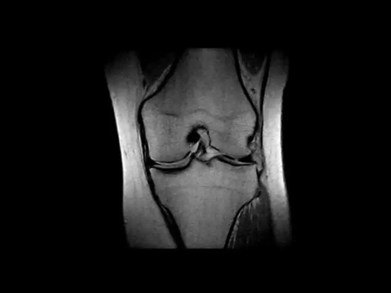 O-scan - Knee PD coronal
