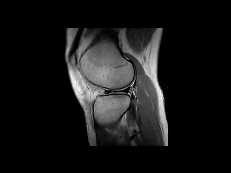 O-scan - Knee PD sagittal