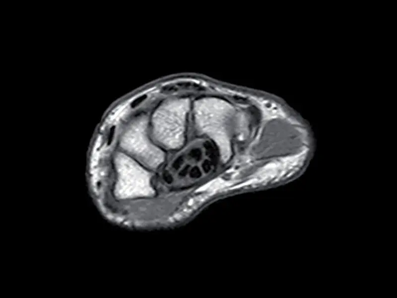 O-scan - Wrist Spin Echo T1 Axial