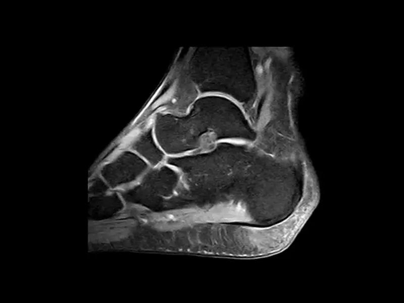 G-scan - Ankle SPED Sagittal