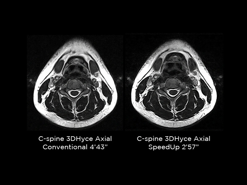 G-scan - C-spine Axial 3DHyce 2