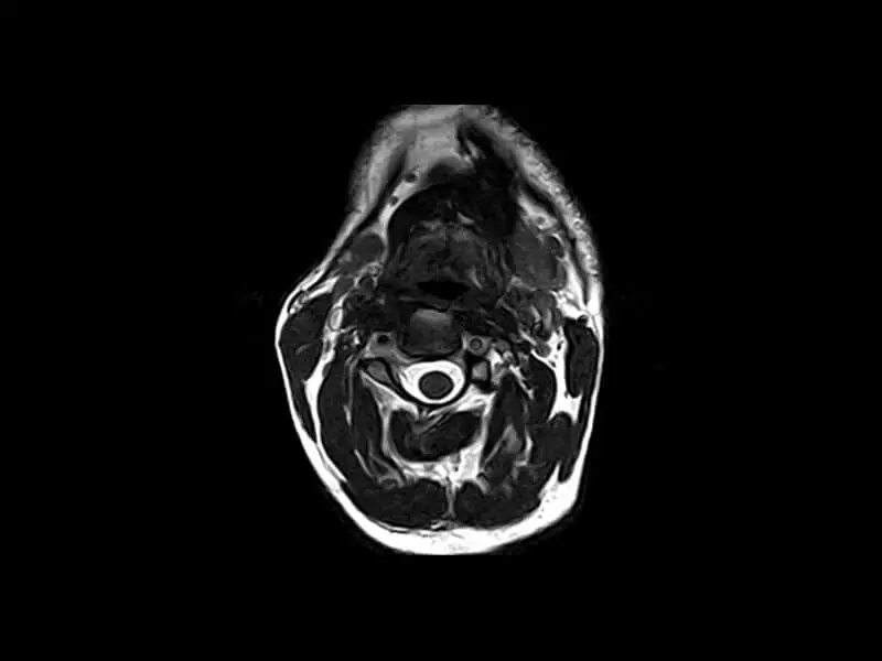 G-scan - Cervical spine 3D HYCE Axial