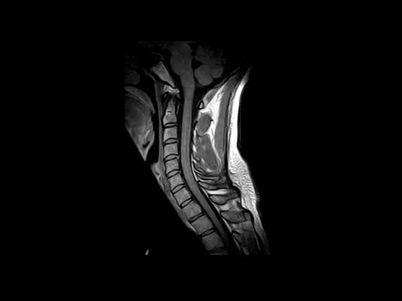 G-scan - Cervical spine SE T1 Sagittal