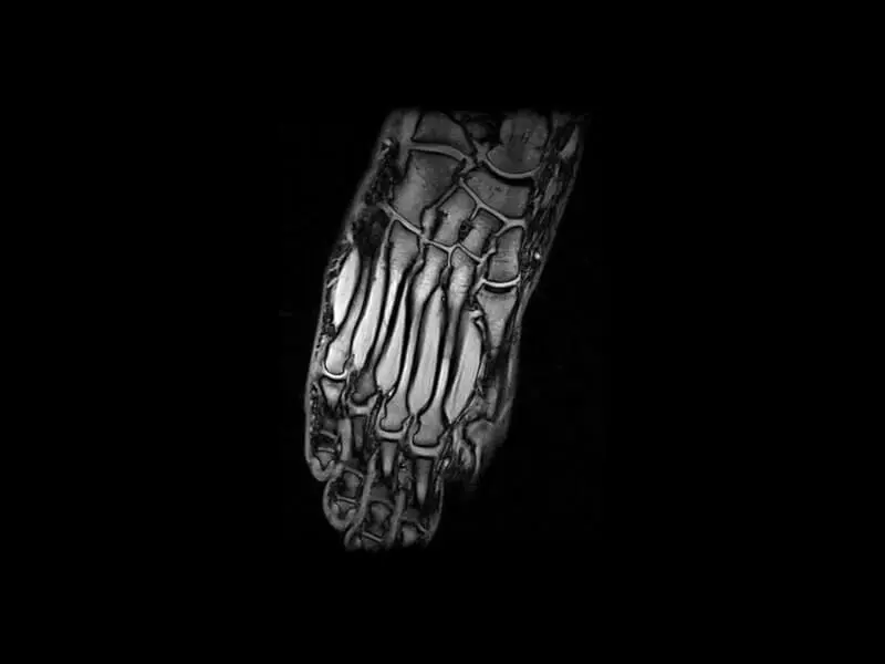G-scan - Foot GE T1 Coronal