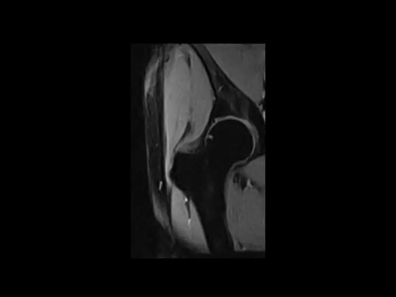 G-scan - Hip XBONE Coronal