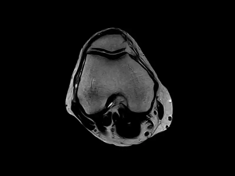 G-scan - Knee FSE T2 Axial