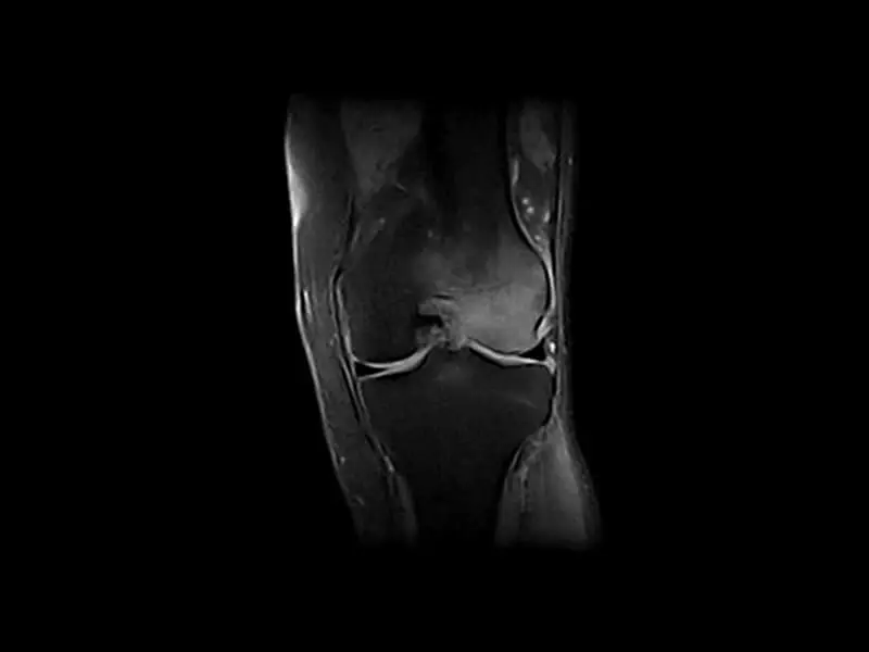 G-scan - Knee SPED Coronal