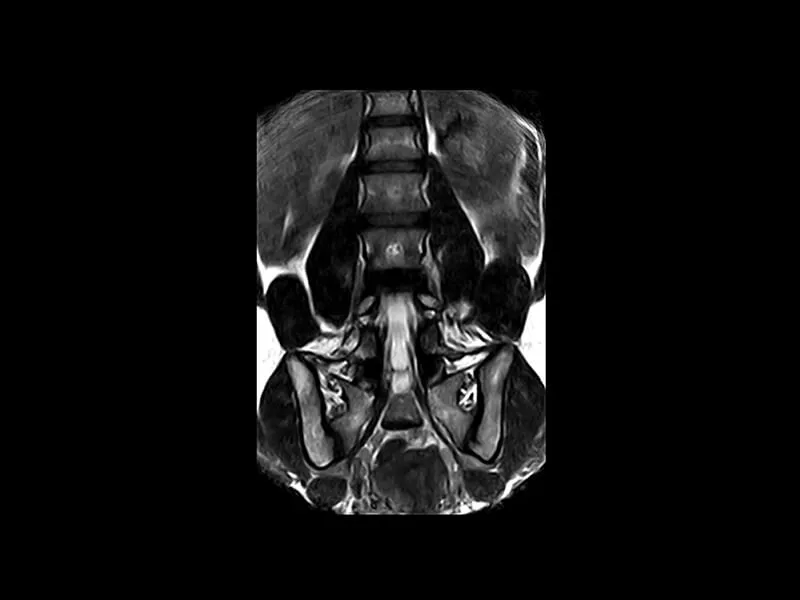 G-scan - L spine 3D HYCE Coronal