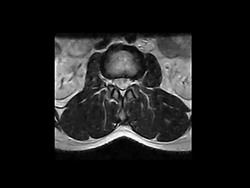 G-scan - L spine FSE T2 Axial