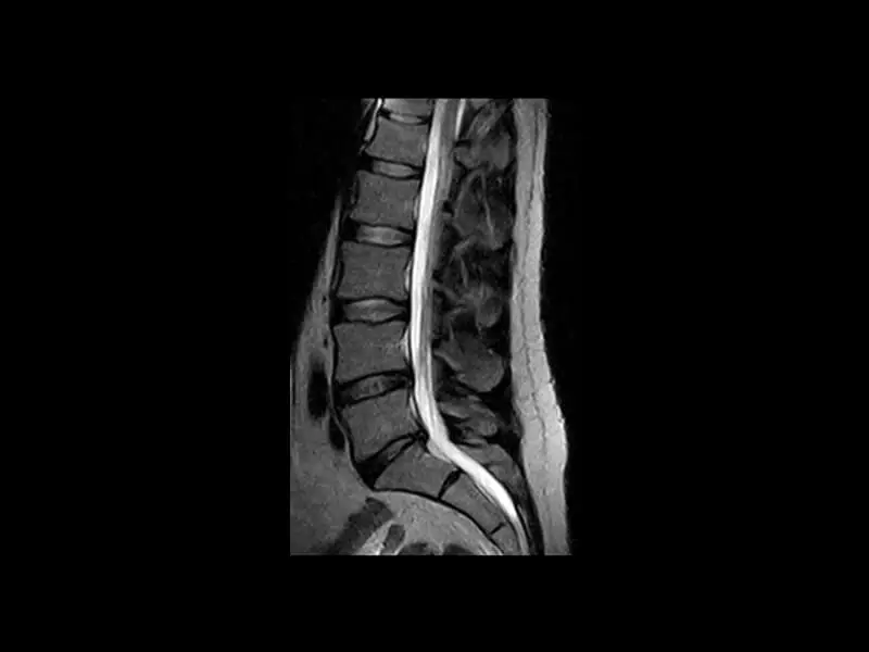 G-scan - L spine FSE T2 Sagittal