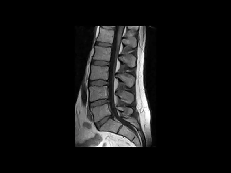 G-scan - L spine SE T1 Sagittal