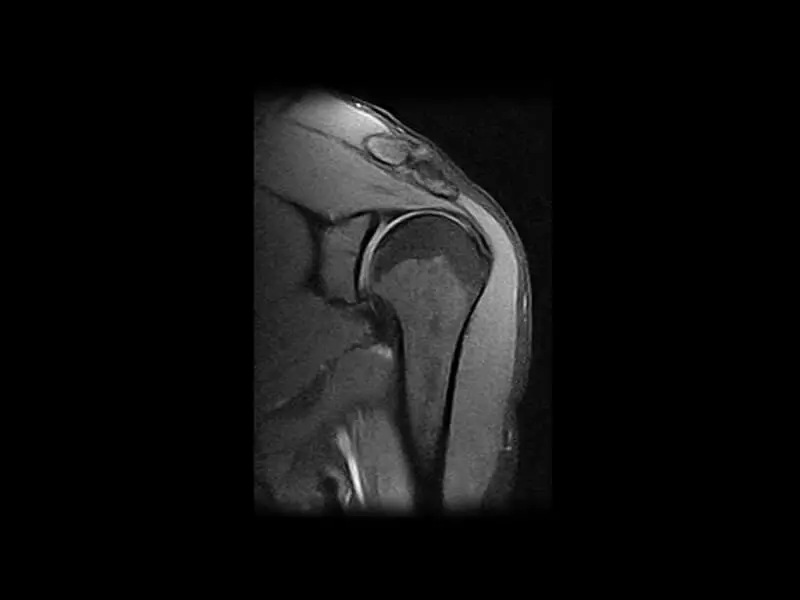 G-scan - Shoulder SPED Coronal