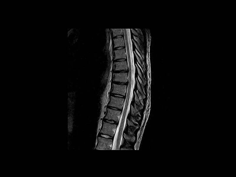 G-scan - T spine FSE T2 Sagittal