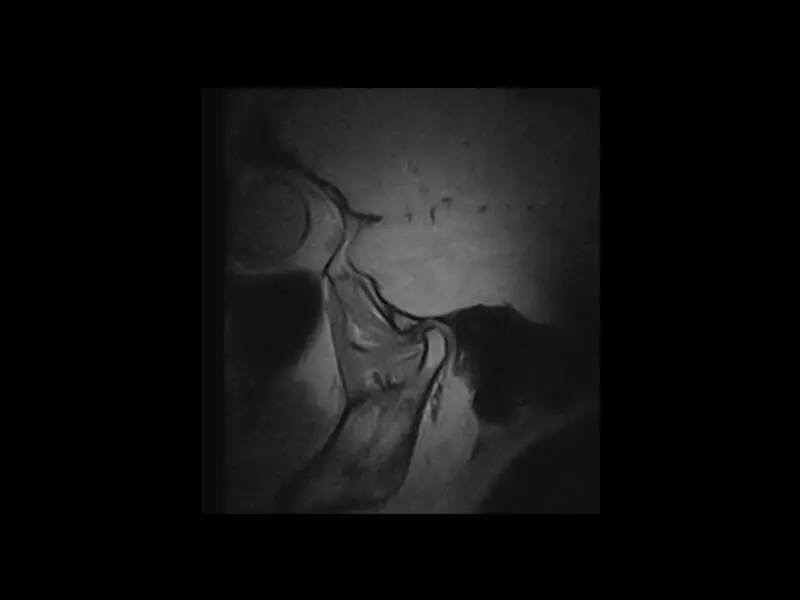 G-scan - TMJ FSE PD Sagittal
