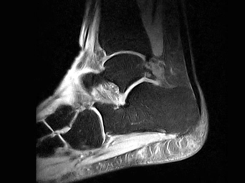 Magnifico™Open - Ankle SPED sagittal