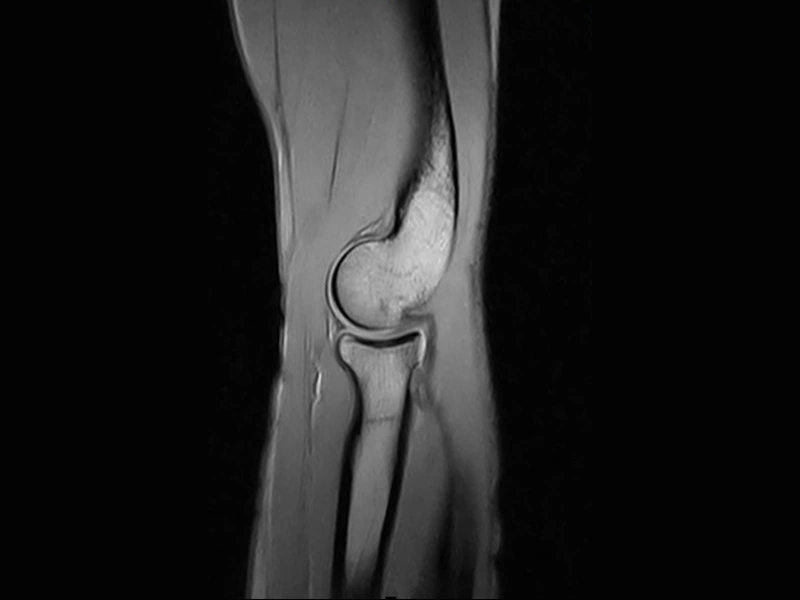 Magnifico™Open - Elbow GE T2 sagittal