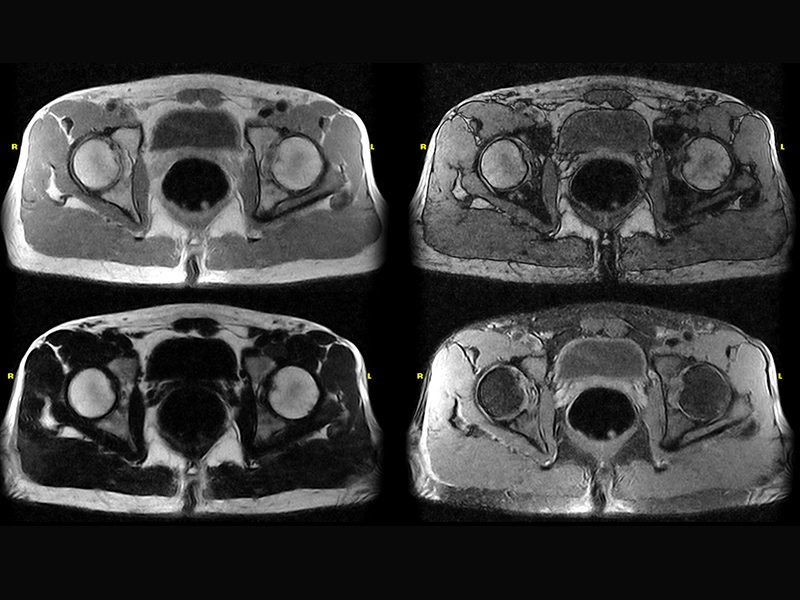 Magnifico™Open - Hip SPED axial