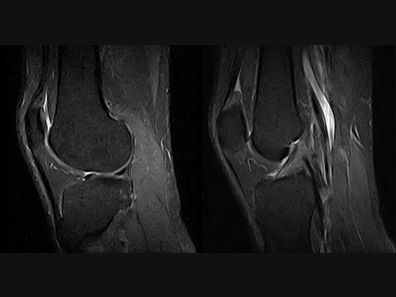 Magnifico™Open - Knee F STIR sagittal