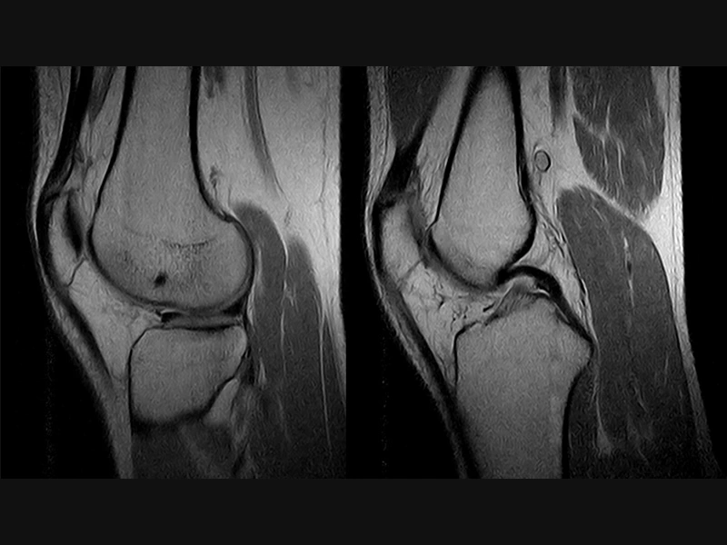 Magnifico™Open - Knee FSE PD sagittal
