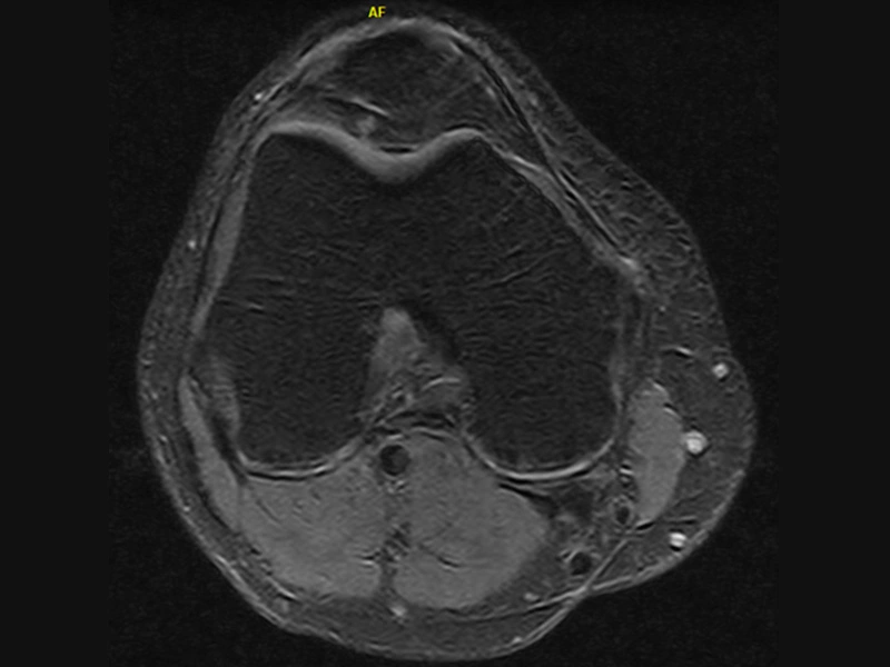 Magnifico™Open - Knee SPED axial
