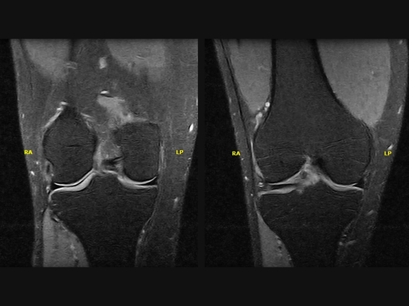 Magnifico™Open - Knee SPED coronal