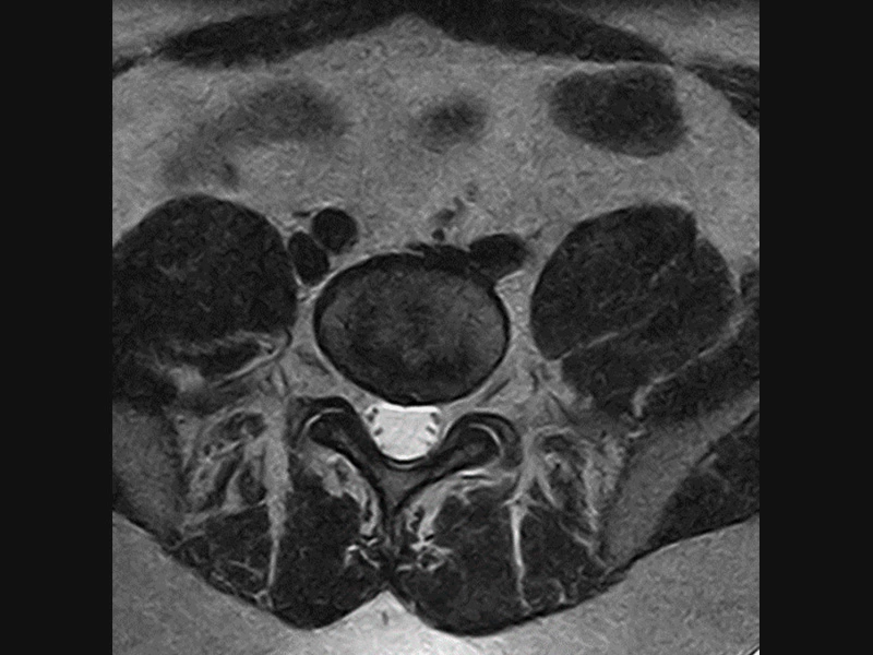 Magnifico™Open - Lspine SE T2 axial