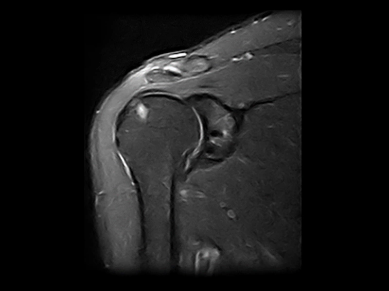 Magnifico™Open - Shoulder F STIR coronal