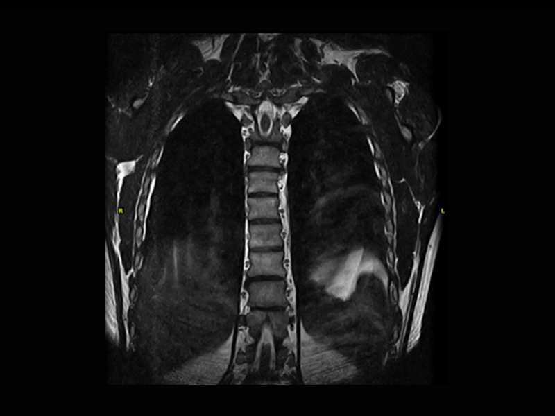 Magnifico™Open - Tspine 3DHYCE coronal