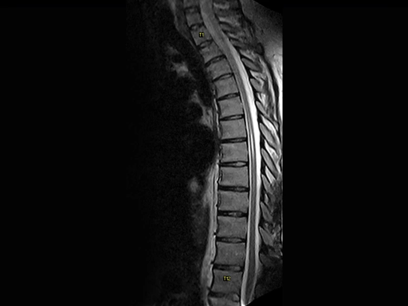 Magnifico™Open - Tspine FSE T2 sagittal