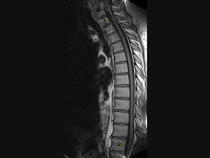 Magnifico™Open - Tspine SE T1 sagittal