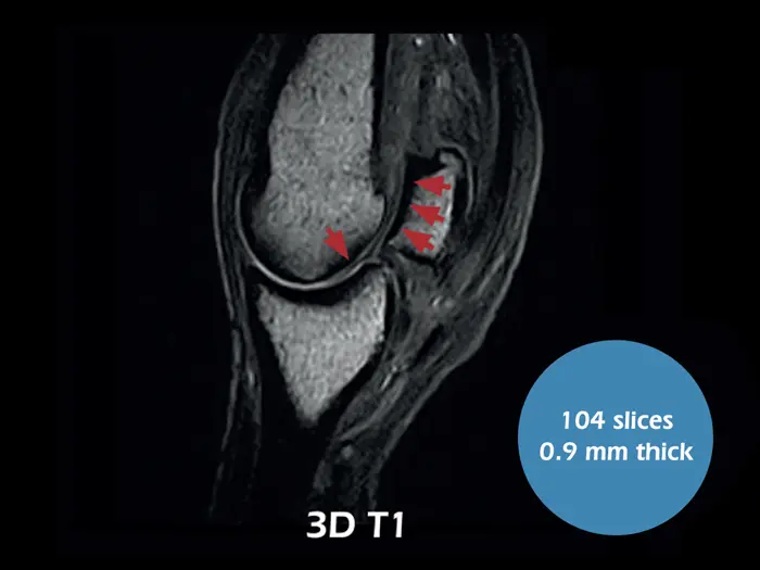 Esaote O-scan VET – 3D T1 Sagittal Fetlock Arthropathy
