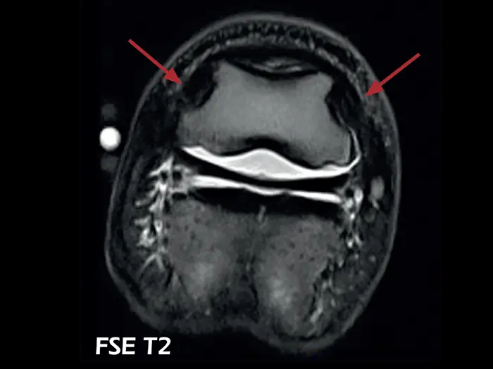 Esaote O-scan VET – FSE T2 Axial Lesion of the collateral ligaments of the coffin joint