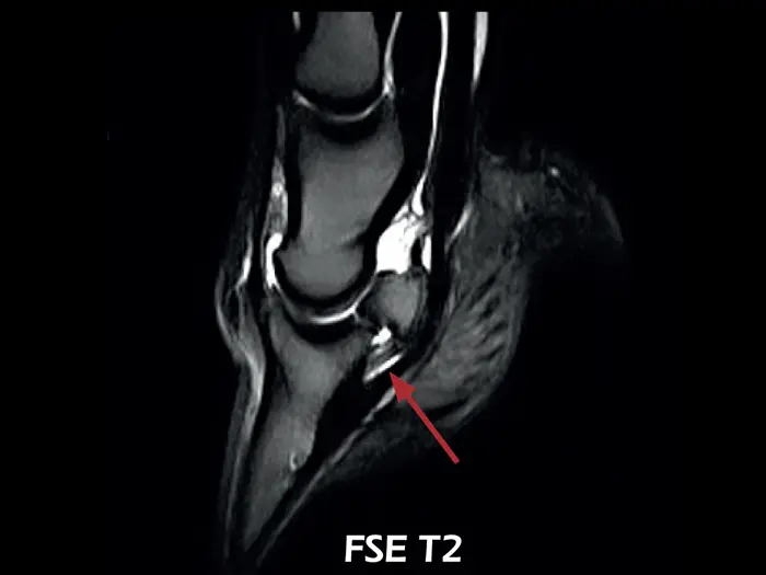 Esaote O-scan VET – FSE T2 Sagittal Lesion of the collateral ligaments of the coffin joint