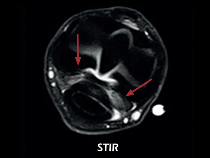 Esaote O-scan VET – STIR Axial-Fetlock Arthropathy