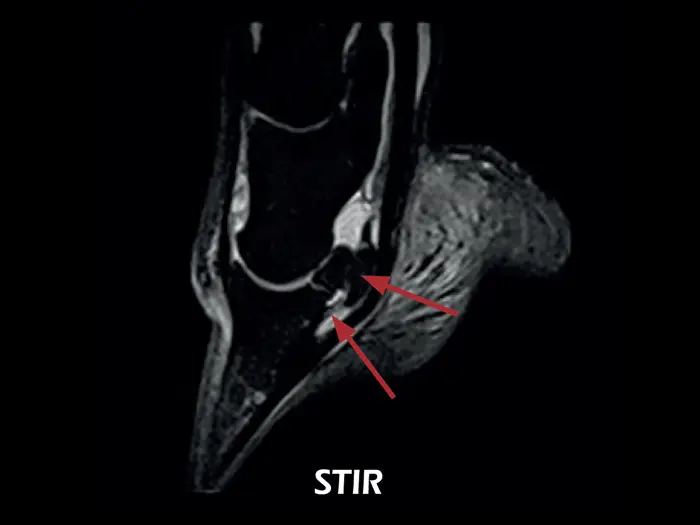 Esaote O-scan VET – STIR Sag Lesion of the collateral ligaments of the coffin joint